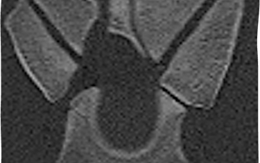 Crossection C67 before surgery with the narrowed intervertebral foramen shown
