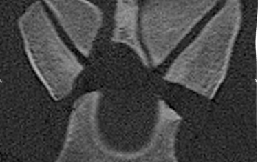The same image after surgery